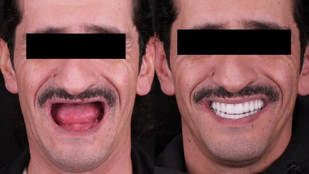 زراعة أسنان All-on-X في مركز د. نور مصطفى